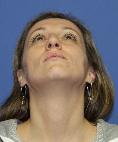 Rhinoplasty 2367 – Click HERE for more views before photo. Individual results may vary.
