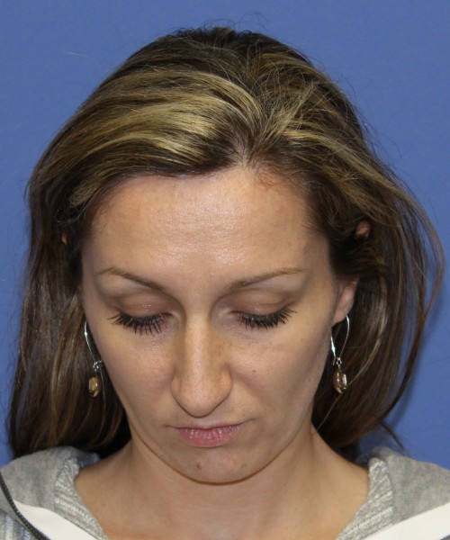 Rhinoplasty 2367 – Click HERE for more views before photo. Individual results may vary.