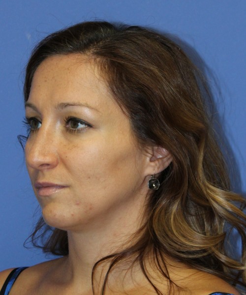 Rhinoplasty 2367 – Click HERE for more views after photo. Individual results may vary.