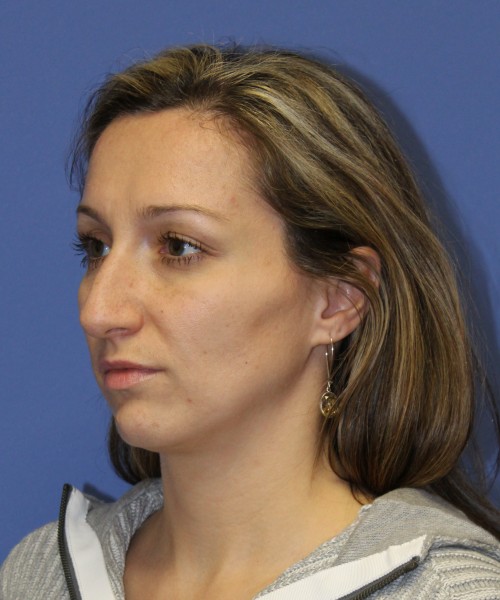 Rhinoplasty 2367 – Click HERE for more views before photo. Individual results may vary.