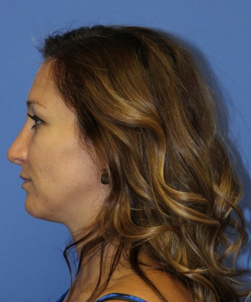 Rhinoplasty 2367 – Click HERE for more views after photo. Individual results may vary.