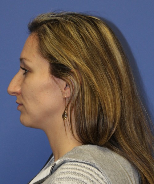 Rhinoplasty 2367 – Click HERE for more views before photo. Individual results may vary.