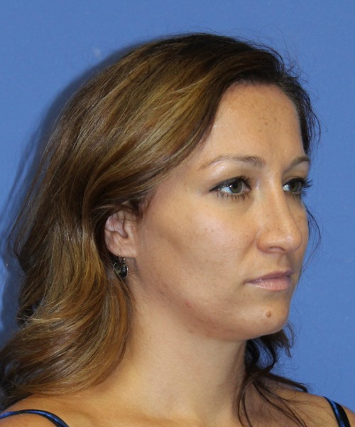Rhinoplasty 2367 – Click HERE for more views after photo. Individual results may vary.