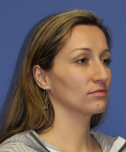 Rhinoplasty 2367 – Click HERE for more views before photo. Individual results may vary.