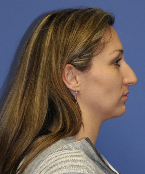 Rhinoplasty 2367 – Click HERE for more views before photo. Individual results may vary.