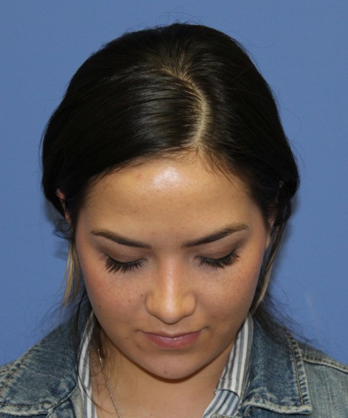 Rhinoplasty 2397 – Click HERE for more views after photo. Individual results may vary.