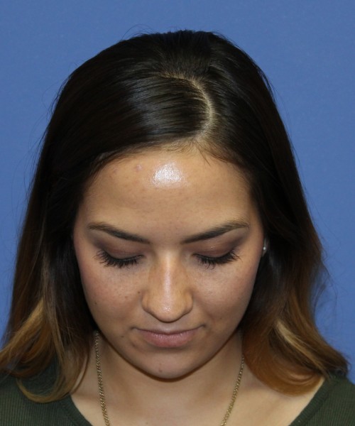 Rhinoplasty 2397 – Click HERE for more views before photo. Individual results may vary.