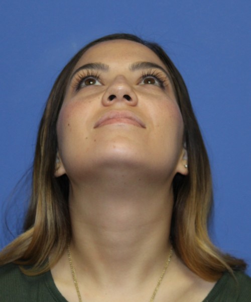 Rhinoplasty 2397 – Click HERE for more views before photo. Individual results may vary.