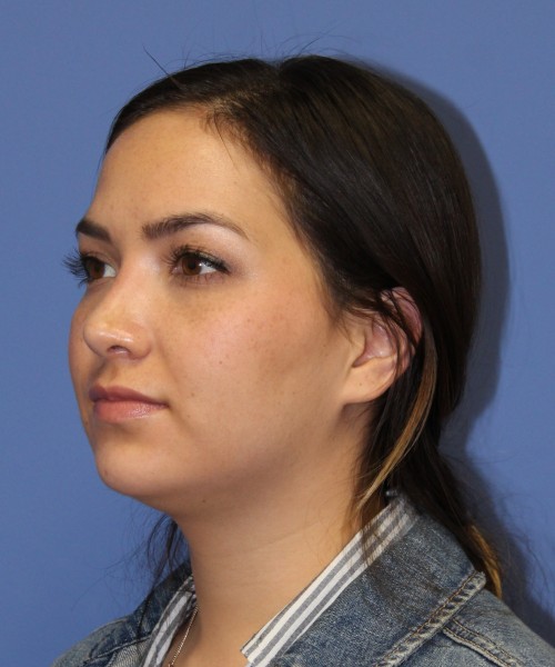 Rhinoplasty 2397 – Click HERE for more views after photo. Individual results may vary.