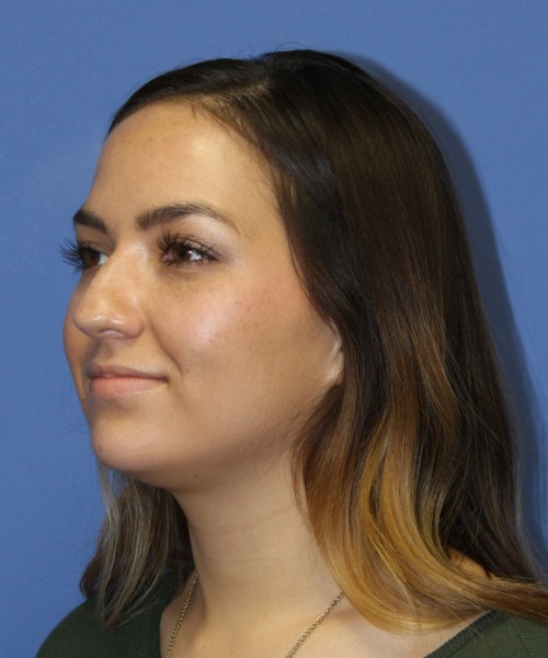 Rhinoplasty 2397 – Click HERE for more views before photo. Individual results may vary.