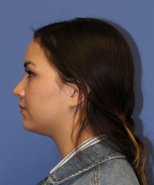 Rhinoplasty 2397 – Click HERE for more views after photo. Individual results may vary.