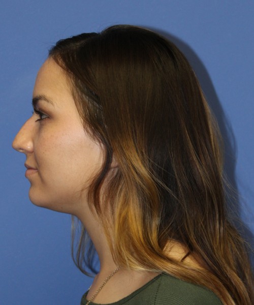 Rhinoplasty 2397 – Click HERE for more views before photo. Individual results may vary.