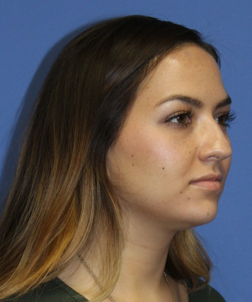 Rhinoplasty 2397 – Click HERE for more views before photo. Individual results may vary.
