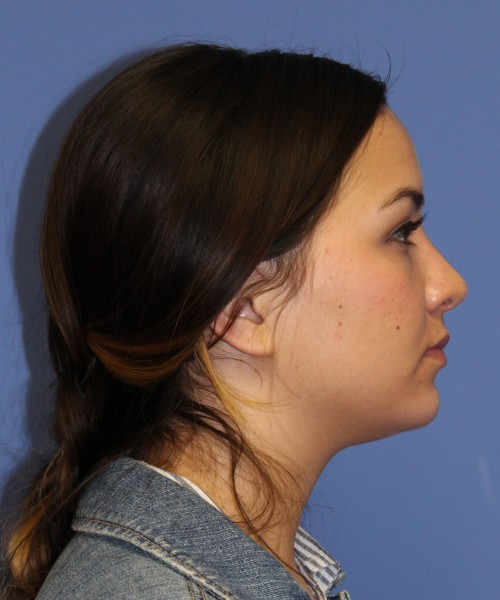 Rhinoplasty 2397 – Click HERE for more views after photo. Individual results may vary.