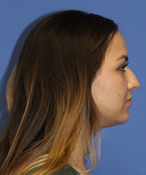 Rhinoplasty 2397 – Click HERE for more views before photo. Individual results may vary.