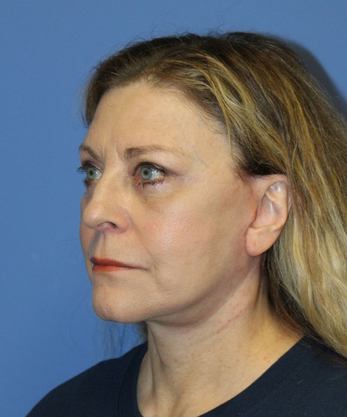 Facelift 2441 – Click HERE for more views after photo. Individual results may vary.