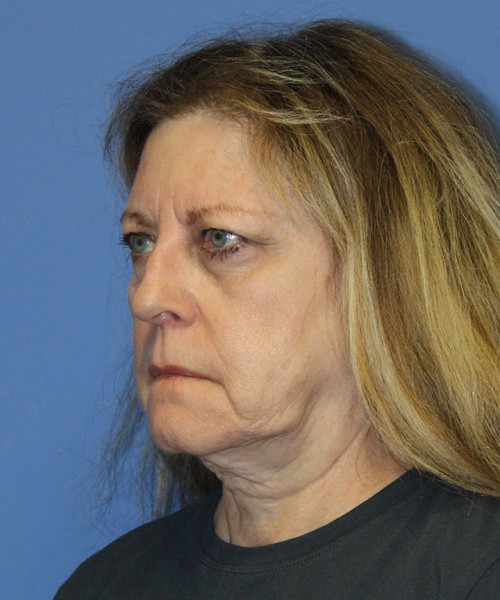 Facelift 2441 – Click HERE for more views before photo. Individual results may vary.