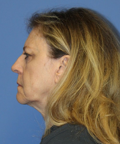 Facelift 2441 – Click HERE for more views before photo. Individual results may vary.