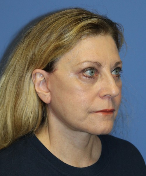 Facelift 2441 – Click HERE for more views after photo. Individual results may vary.