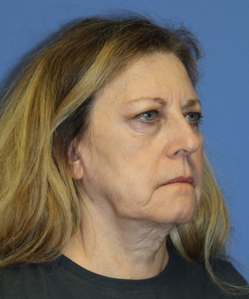 Facelift 2441 – Click HERE for more views before photo. Individual results may vary.