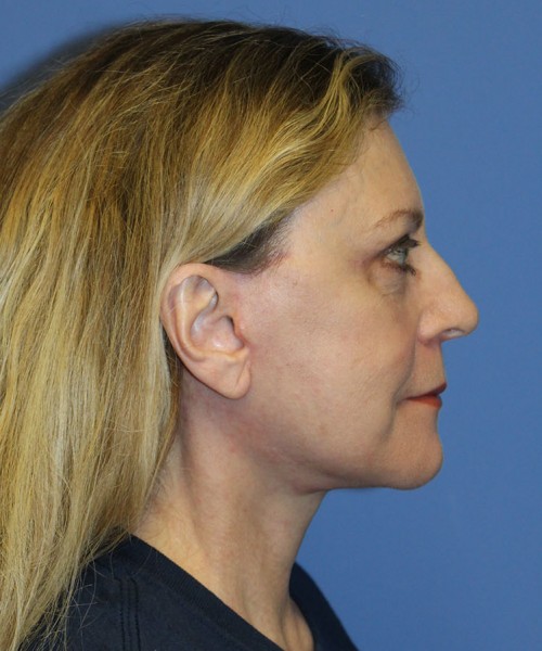 Facelift 2441 – Click HERE for more views after photo. Individual results may vary.