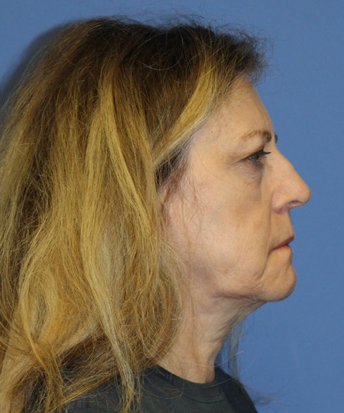 Facelift 2441 – Click HERE for more views before photo. Individual results may vary.
