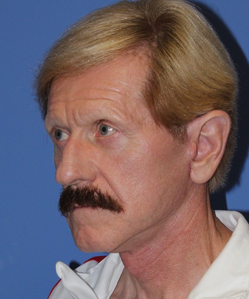 Facelift 2452 – Click HERE for more views after photo. Individual results may vary.