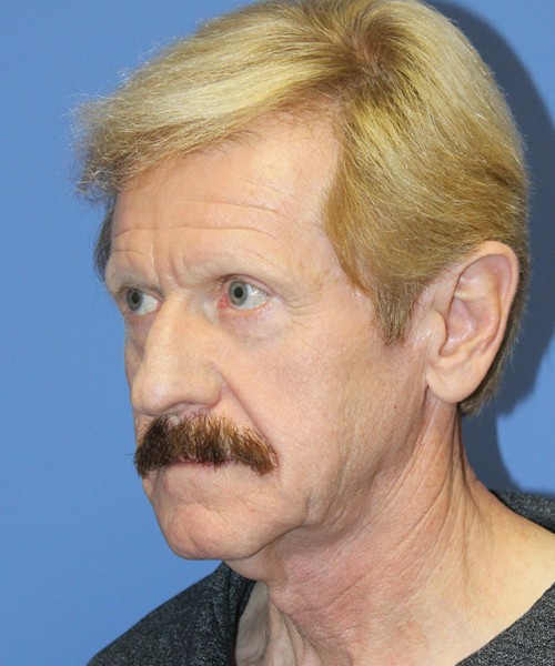 Facelift 2452 – Click HERE for more views before photo. Individual results may vary.