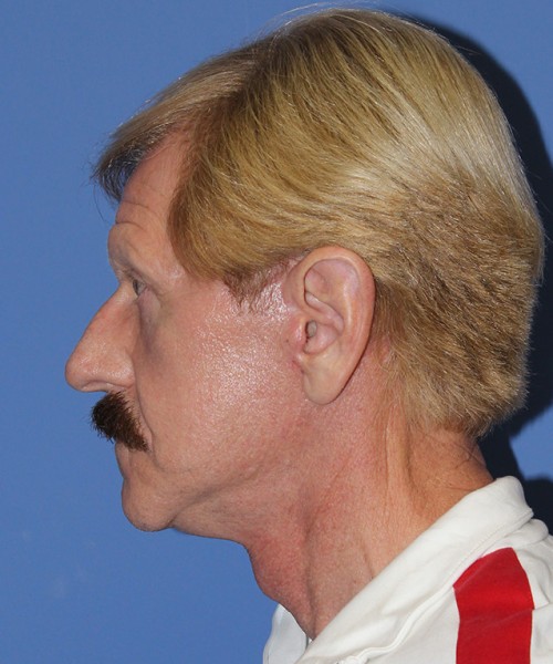 Facelift 2452 – Click HERE for more views after photo. Individual results may vary.