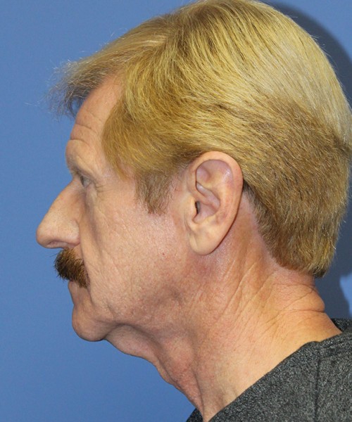 Facelift 2452 – Click HERE for more views before photo. Individual results may vary.