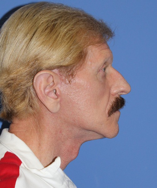 Facelift 2452 – Click HERE for more views after photo. Individual results may vary.