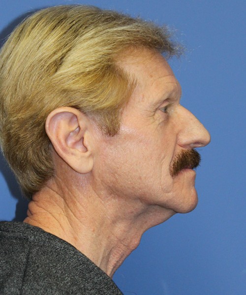 Facelift 2452 – Click HERE for more views before photo. Individual results may vary.