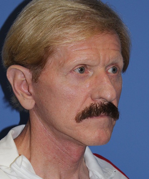 Facelift 2452 – Click HERE for more views after photo. Individual results may vary.