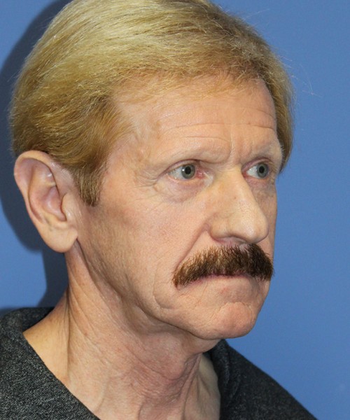 Facelift 2452 – Click HERE for more views before photo. Individual results may vary.