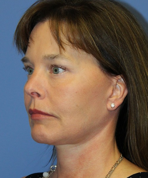 Facelift 2474 – Click HERE for more views after photo. Individual results may vary.