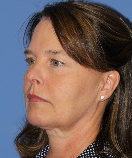 Facelift 2474 – Click HERE for more views before photo. Individual results may vary.
