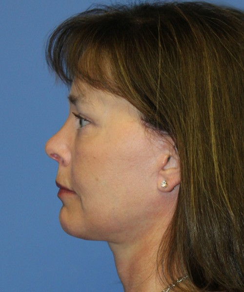Facelift 2474 – Click HERE for more views after photo. Individual results may vary.