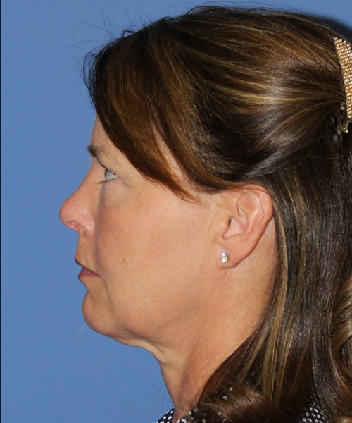 Facelift 2474 – Click HERE for more views before photo. Individual results may vary.