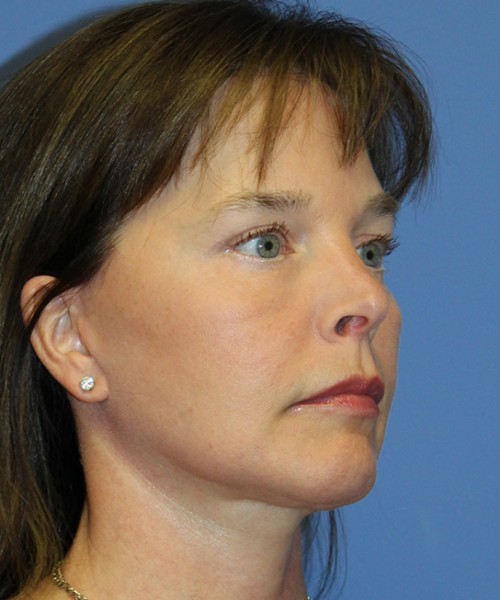Facelift 2474 – Click HERE for more views after photo. Individual results may vary.