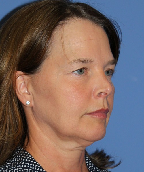 Facelift 2474 – Click HERE for more views before photo. Individual results may vary.