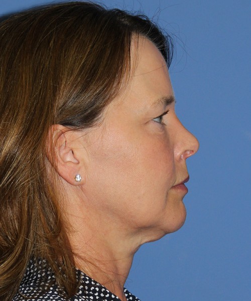 Facelift 2474 – Click HERE for more views before photo. Individual results may vary.