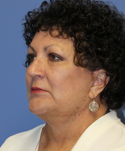 Facelift 2485 – Click HERE for more views after photo. Individual results may vary.