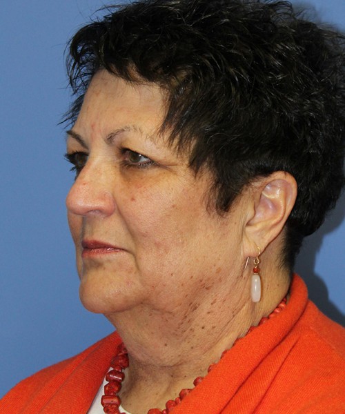 Facelift 2485 – Click HERE for more views before photo. Individual results may vary.