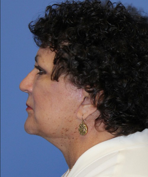 Facelift 2485 – Click HERE for more views after photo. Individual results may vary.