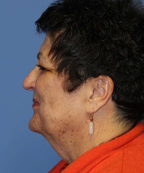 Facelift 2485 – Click HERE for more views before photo. Individual results may vary.