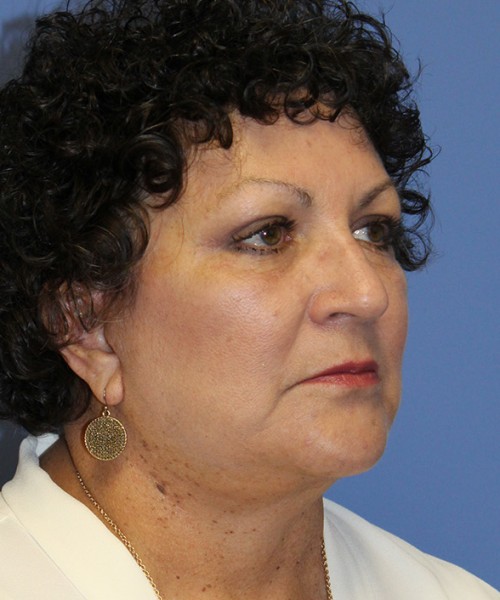 Facelift 2485 – Click HERE for more views after photo. Individual results may vary.