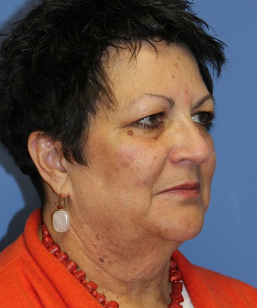 Facelift 2485 – Click HERE for more views before photo. Individual results may vary.
