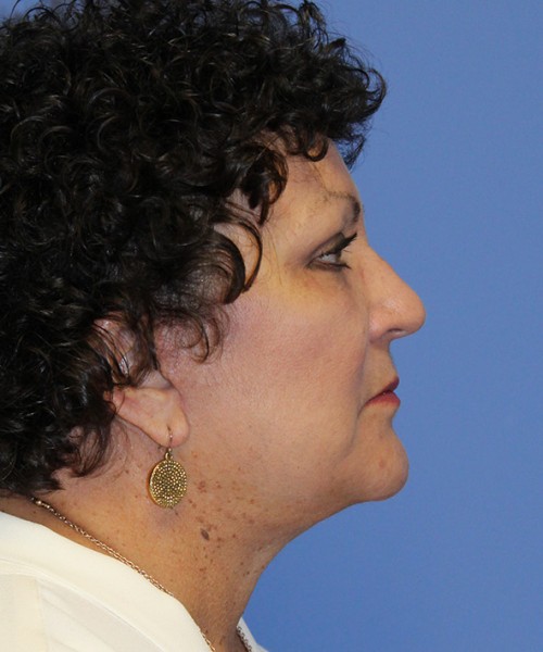 Facelift 2485 – Click HERE for more views after photo. Individual results may vary.