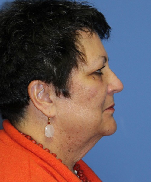 Facelift 2485 – Click HERE for more views before photo. Individual results may vary.