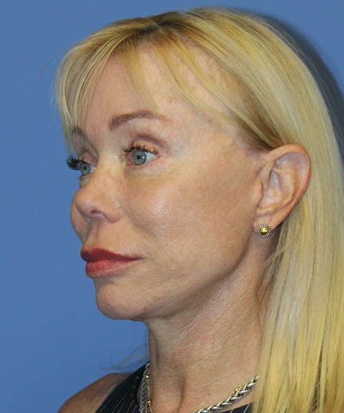 Facelift 2496 – Click HERE for more views after photo. Individual results may vary.